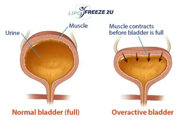 diagram of overactive bladder treatment Taunton