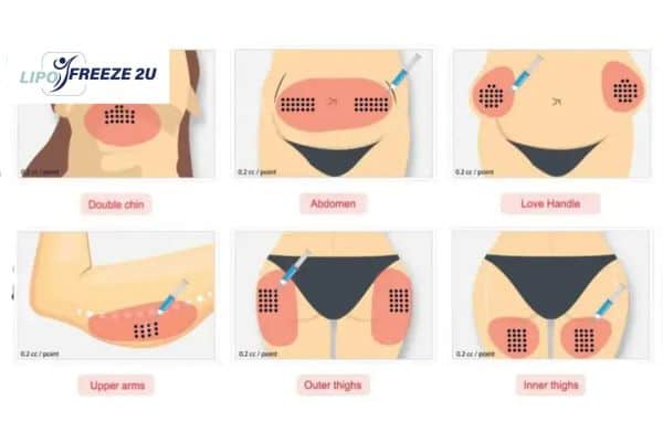Benefits of Choosing Aqualyx for Fat Reduction Taunton