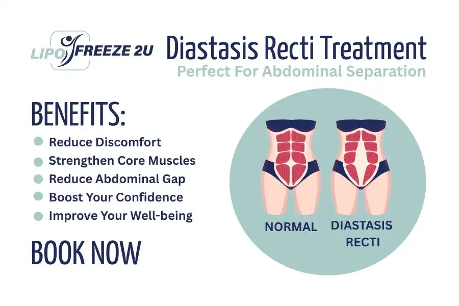 Benefits of body toning treatment Taunton for Diastasis recti