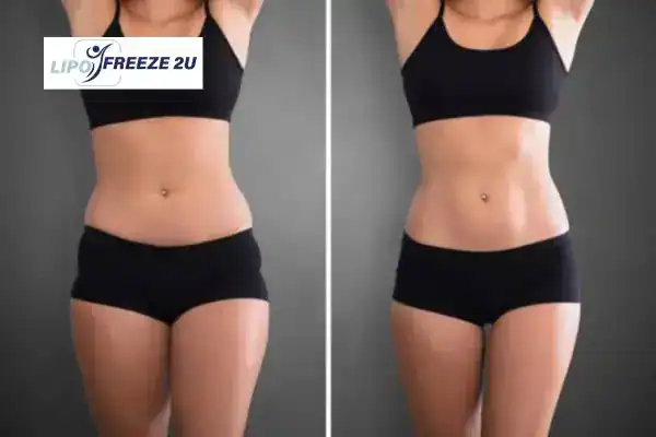 How Can LIPO FREEZE 2U Support Your Post-Pregnancy Body Recovery Taunton?