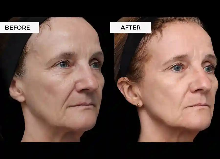 How Many RF Microneedling Sessions Will You Need to See a Difference Taunton?