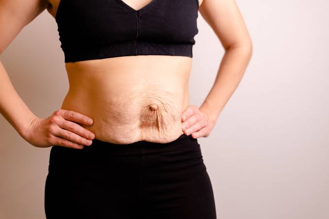 Is Surgery Really the Only Way to Repair Diastasis Recti Taunton?