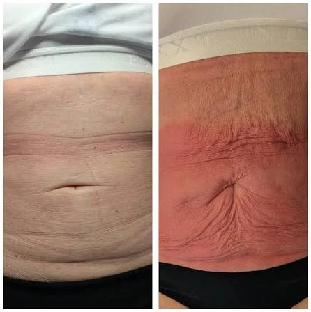 How Does RF Microneedling Improve Crepey, Thin and Uneven Skin Texture Taunton?