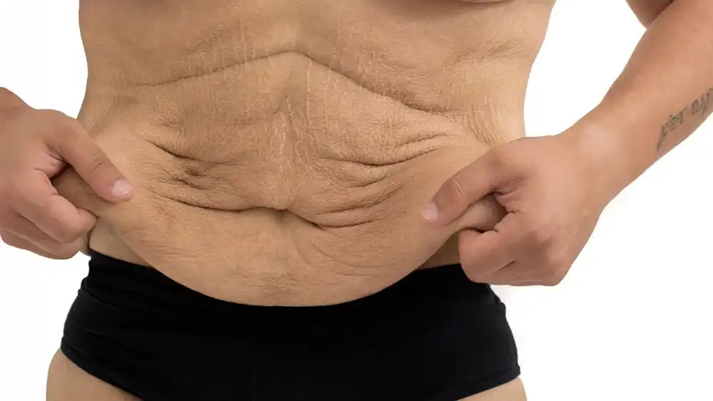 Why Does Weight Loss Medication Leave Some People With Loose or Sagging Skin Taunton?